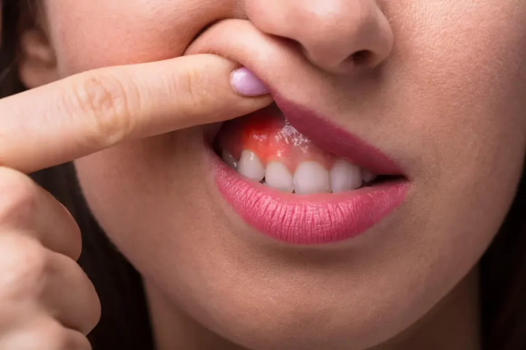 Gingivitis