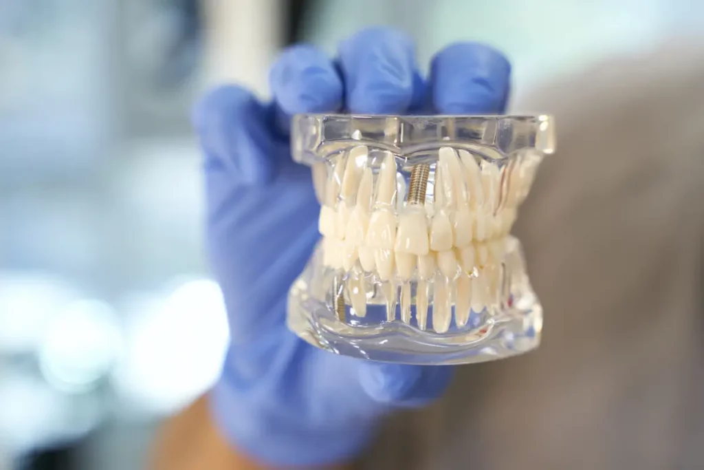 Implantes dentales en Córdoba, España