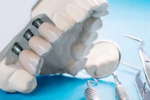 Precios de los implantes dentales en Córdoba 2025
