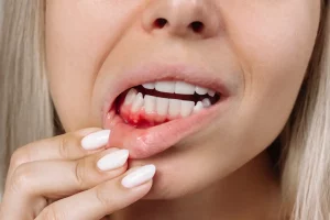 Tratamiento de Periodoncia