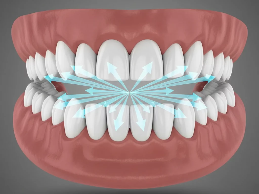 cuidado de los implantes dentales