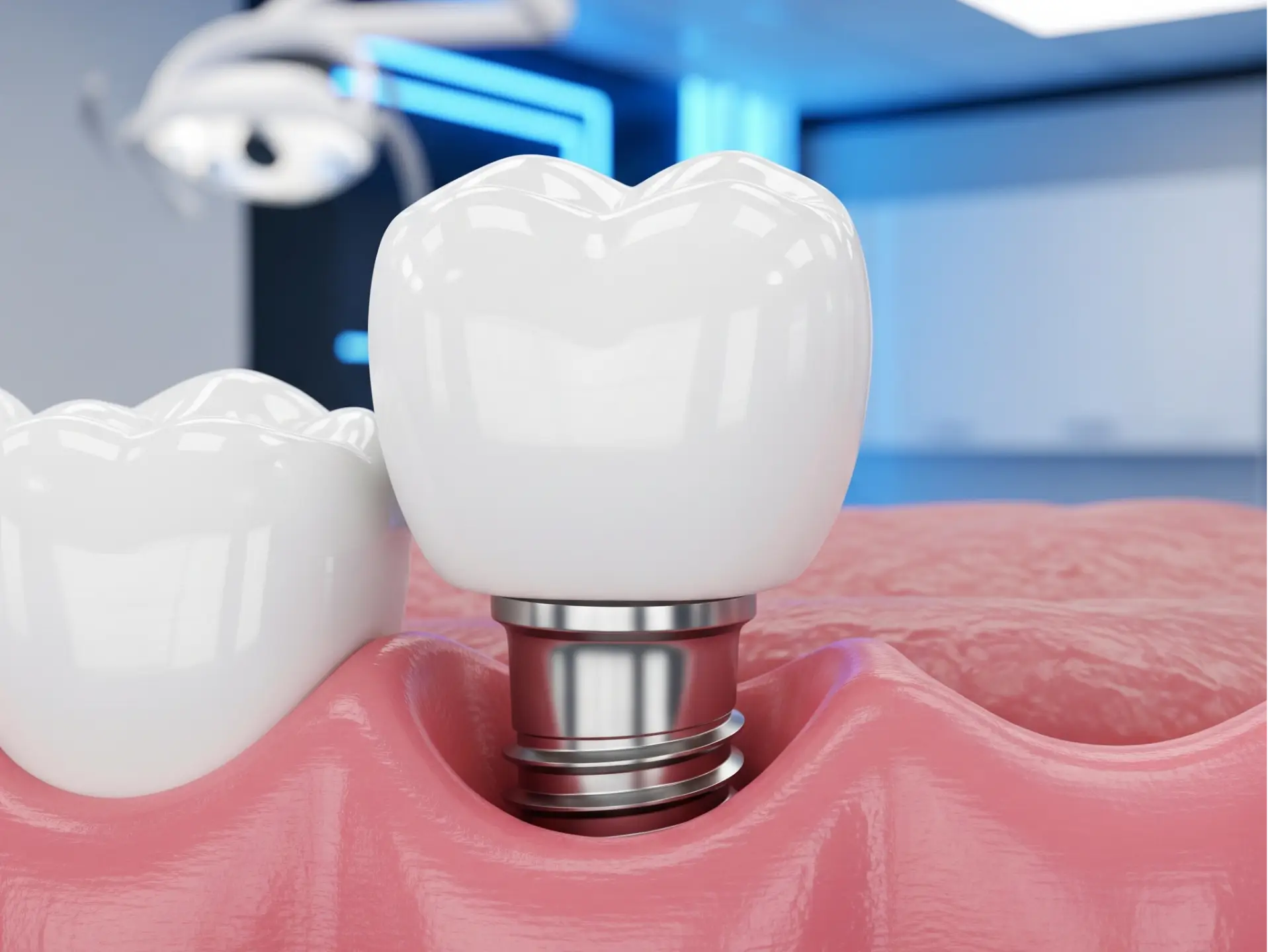 implantes dentales de carga inmediata