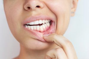 sangrado de encías en Córdoba síntoma de enfermedad periodontal
