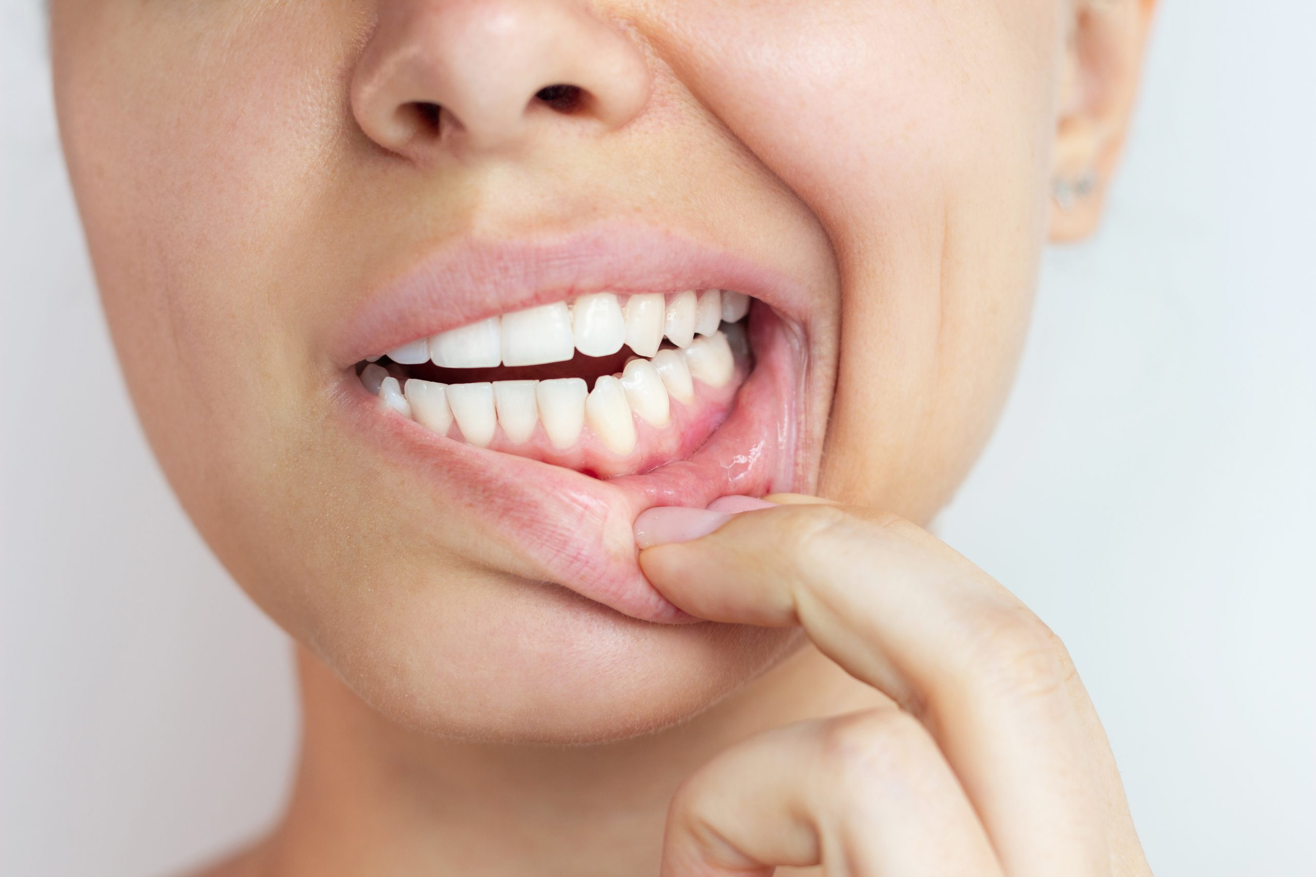 sangrado de encías en Córdoba síntoma de enfermedad periodontal