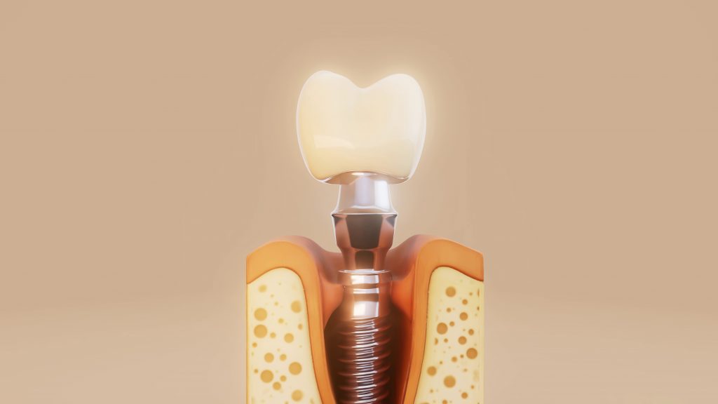implantes de carga inmediata en Córdoba en clínica dental