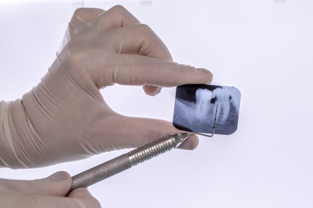 radiografía dental para diagnóstico de implantes dentales en Córdoba
